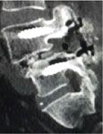New technique for inserting screws in osteoporotic patients