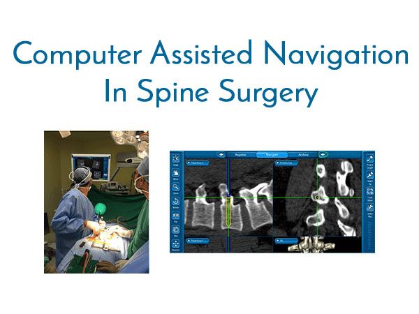 Computer Assisted Spine Surgery