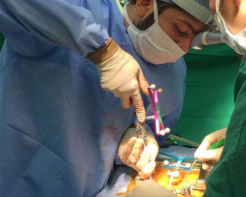 Minimally invasive and navigation guided spine surgery
