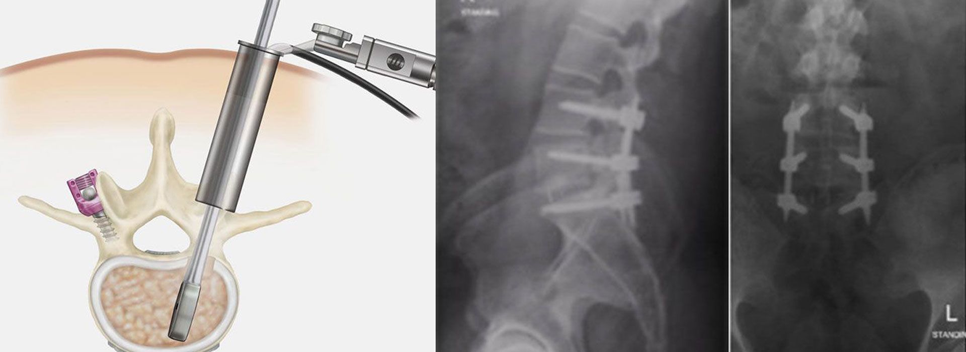 Minimally invasive and navigation guided spine surgery