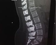 Minimally Invasive Spinal Trauma Fixation
