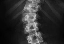 Minimally Invasive Spinal Tumor Surgery